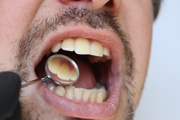 Four Benefits Of A Dental Cleaning